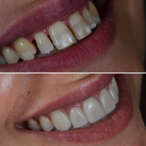Facetas Cerâmicas - Dr. Pedro Sá