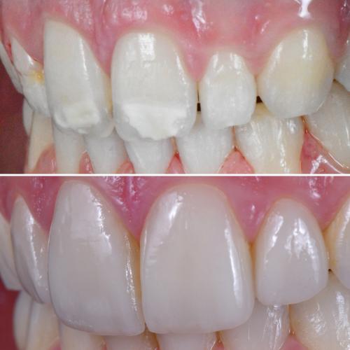 Facetas Cerâmicas - Dr. Pedro Sá