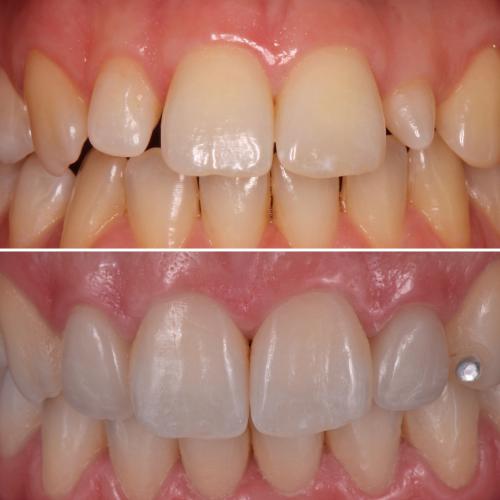 Facetas Cerâmicas - Dr. Pedro Sá
