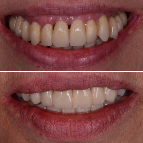 Implantes Dentários e regeneração ossea - Dr. Pedro Sá