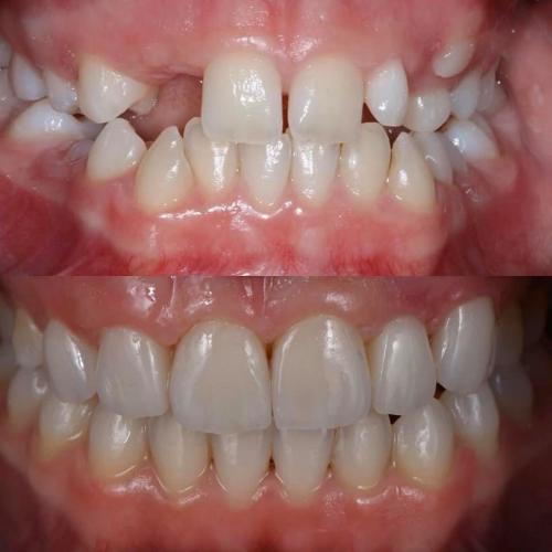 Implantes Dentários - Dr. Pedro Sá e Ortodontia Drª Susana Melo