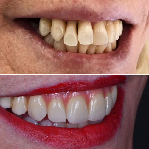 Implantes Dentários - Dr. Pedro Sá